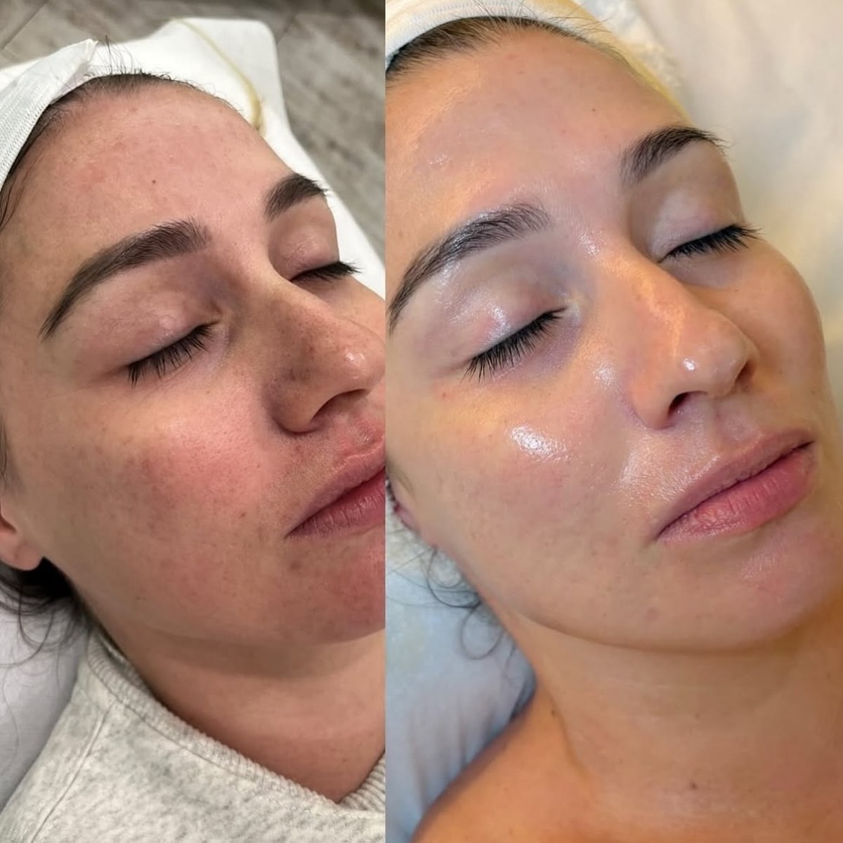 Before and after photo of a patient treated at VTIARA Clinic, Bangalore
