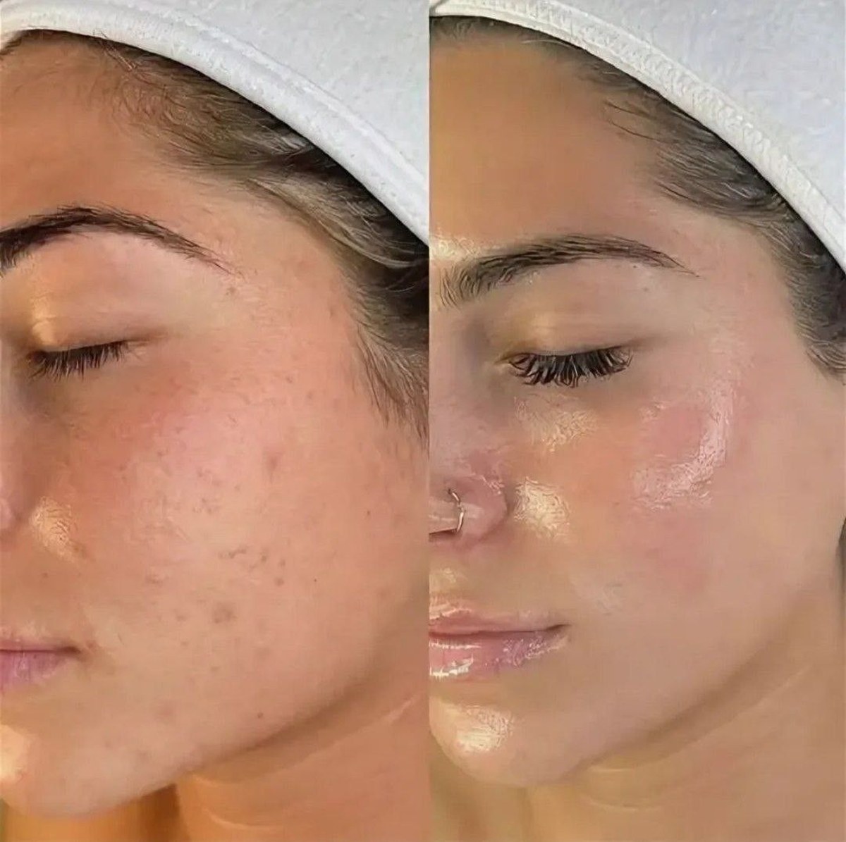 Before and after photo of a patient treated at VTIARA Clinic, Bangalore